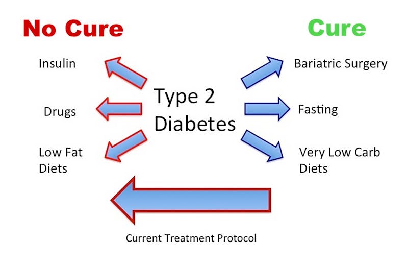 Cure or nu cure for type 2 diabetes