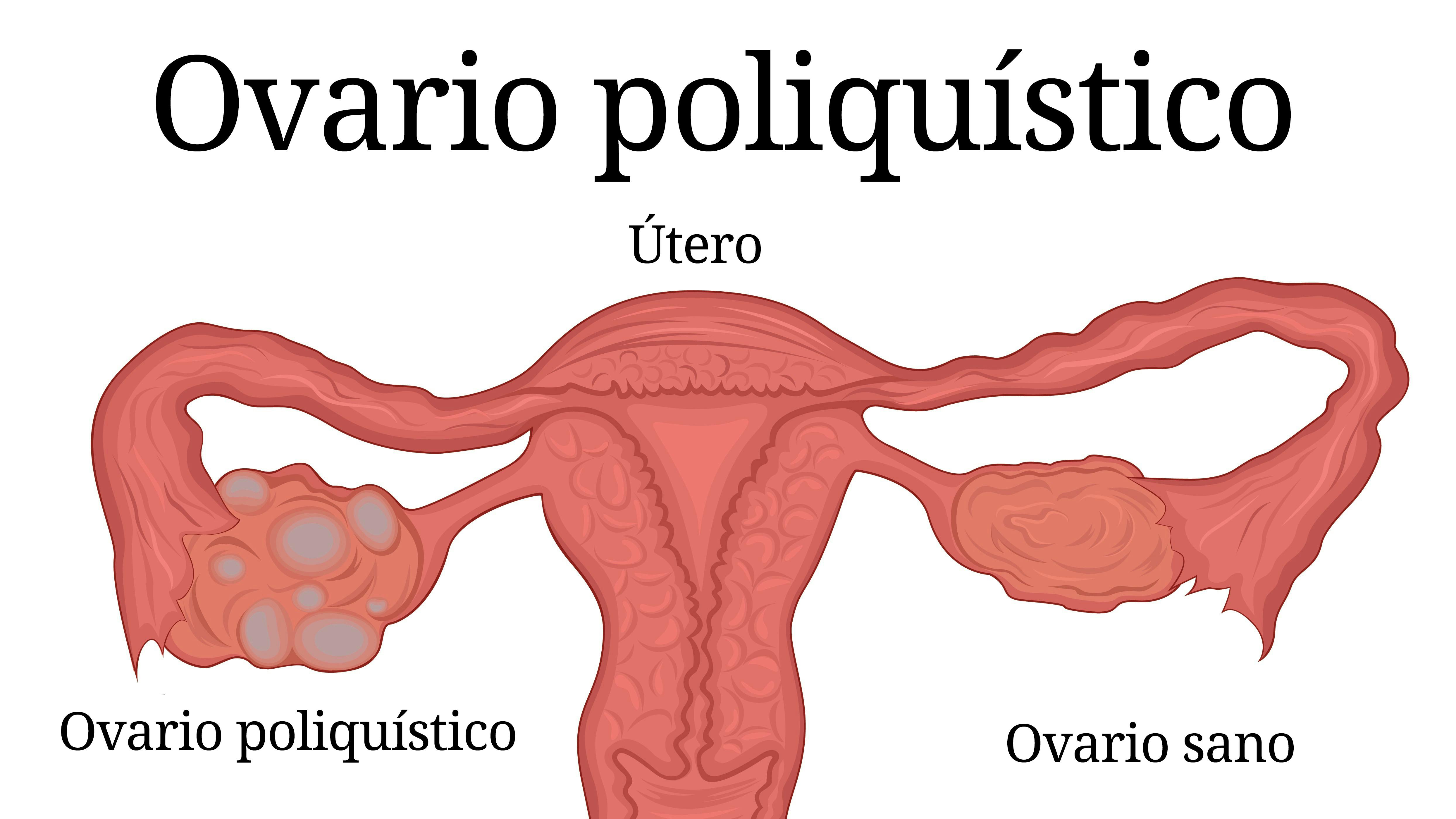 Síndrome del ovario poliquístico e hiperandrogenismo: SOP 7 - Diet Doctor