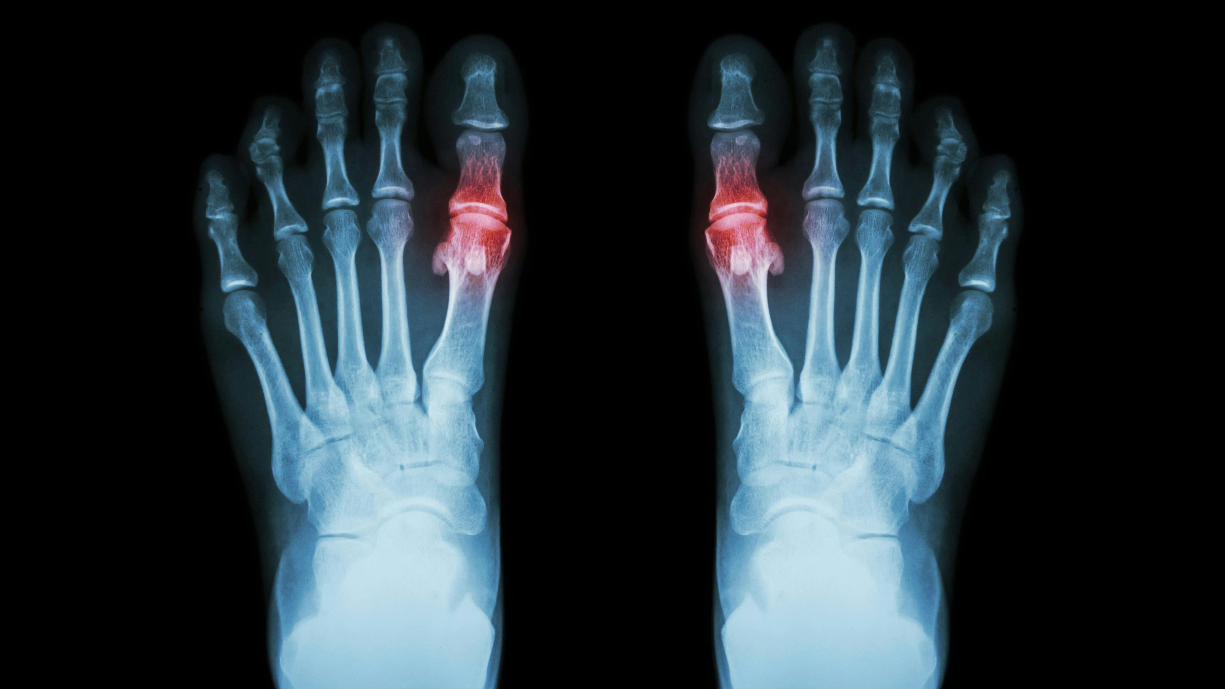 Gout , Rheumatoid arthritis